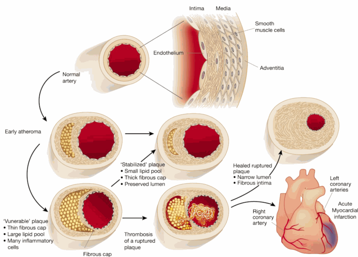 下面这张图就展示了血管发生动脉粥样硬化以后会变成什么样子.